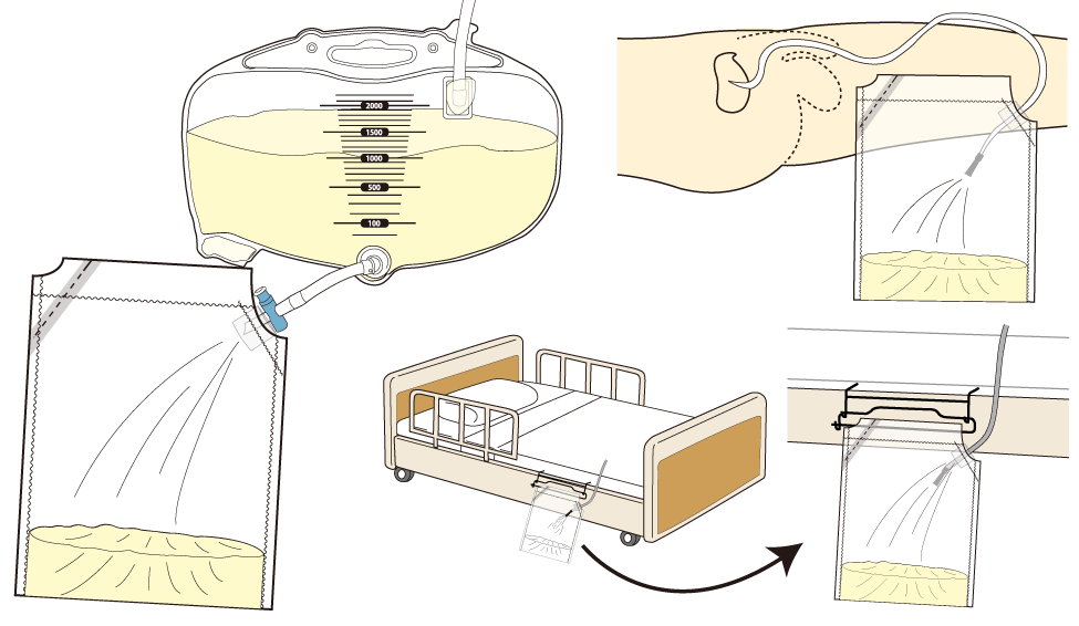 ユーリンケアV2、吊り下げ金具で吊り下げている画像、逆止弁付き、斜めにカットできるので簡単排尿、尿・臭いが拡散しない