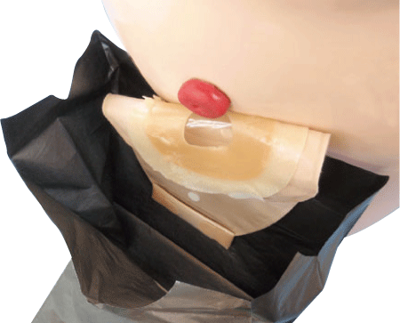 オルトケアで安心してストーマの交換ができます